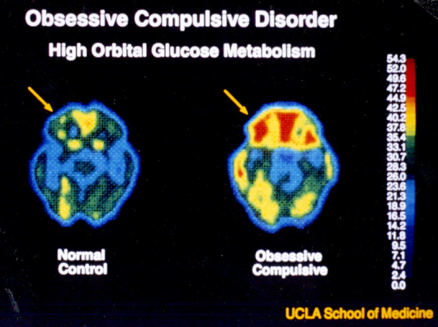 OCD PET scan image showing the brain on fire!